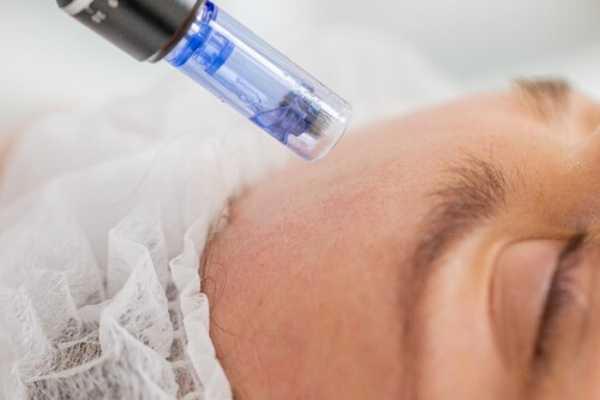 RF Microneedling Salem Skin Tightening & Lifting